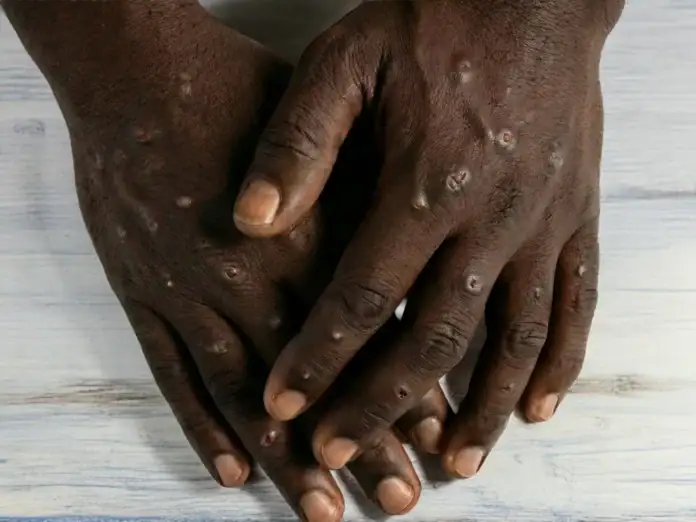 Les Comores touchées par l’épidémie de Mpox Les Comores touchées par l’épidémie de Mpox