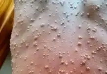 Mpox à Mayotte : situation stable selon l’ARS, afflux attendu chez les médecins après la décision des Comores Mpox à Mayotte : situation stable selon l’ARS, afflux attendu chez les médecins après la décision des Comores