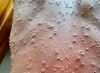 Mpox à Mayotte : situation stable selon l’ARS, afflux attendu chez les médecins après la décision des Comores Mpox à Mayotte : situation stable selon l’ARS, afflux attendu chez les médecins après la décision des Comores