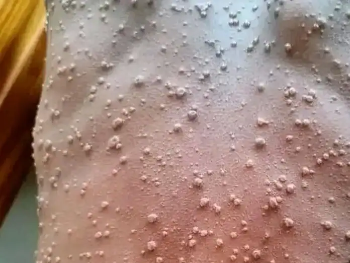 Mpox à Mayotte : situation stable selon l’ARS, afflux attendu chez les médecins après la décision des Comores