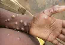 Mpox : deux cas confirmés à Mayotte Mpox : deux cas confirmés à Mayotte