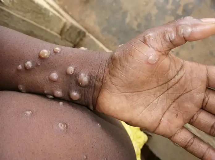 Mpox : deux cas confirmés à Mayotte Mpox : deux cas confirmés à Mayotte