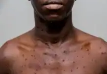 Un premier cas de Mpox confirmé à Mayotte, les autorités sanitaires renforcent la vigilance Un premier cas de Mpox confirmé à Mayotte, les autorités sanitaires renforcent la vigilance