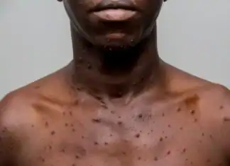 Un premier cas de Mpox confirmé à Mayotte, les autorités sanitaires renforcent la vigilance Un premier cas de Mpox confirmé à Mayotte, les autorités sanitaires renforcent la vigilance