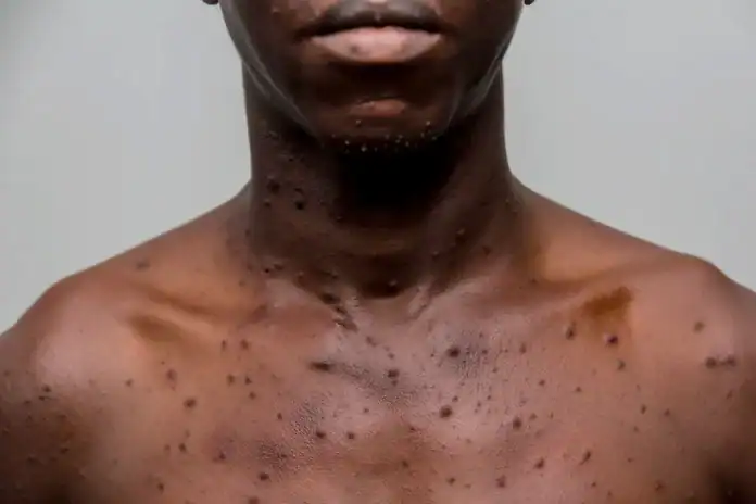 Un premier cas de Mpox confirmé à Mayotte, les autorités sanitaires renforcent la vigilance