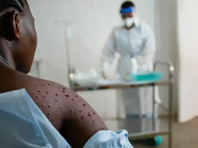 Variole du singe : l’alerte monte à Madagascar