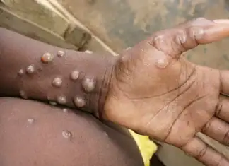 Mpox à Mayotte : neuf cas confirmés, l’ARS mise sur le ciblage et la prévention Mpox à Mayotte : neuf cas confirmés, l’ARS mise sur le ciblage et la prévention