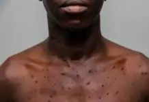 Six cas de Mpox confirmés à Mayotte depuis le début de l’année Six cas de Mpox confirmés à Mayotte depuis le début de l’année