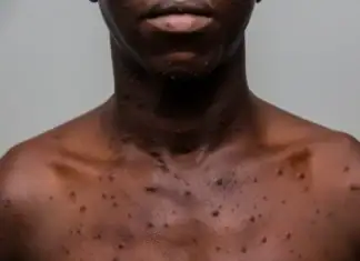 Six cas de Mpox confirmés à Mayotte depuis le début de l’année Six cas de Mpox confirmés à Mayotte depuis le début de l’année