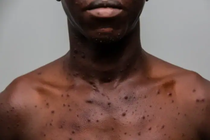 Six cas de Mpox confirmés à Mayotte depuis le début de l’année