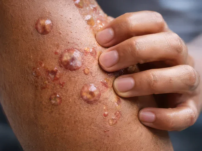 Un nouveau cas importé de Mpox, risque jugé limité